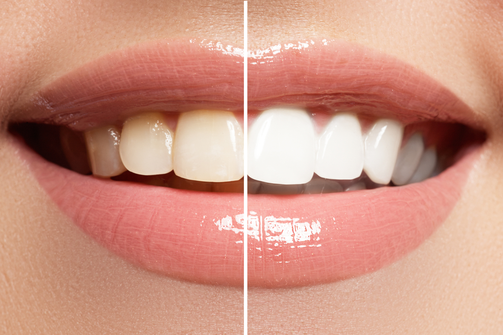 Professional Teeth Whitening in Adelaide