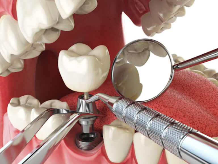 How to know if dental implants are right for you