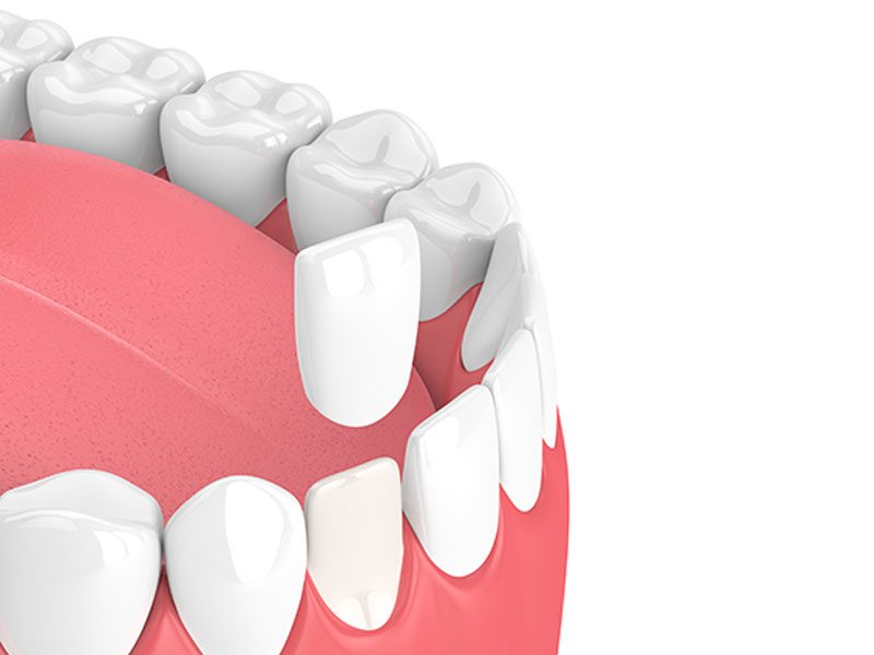 Dental veneers in adelaide